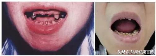 每天认真刷牙为什么会有牙菌斑,每天认真的刷牙牙还是在坏怎么办