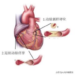 阿托伐他汀钙片降血脂降尿酸,阿托伐他汀和瑞舒伐他汀哪个升尿酸