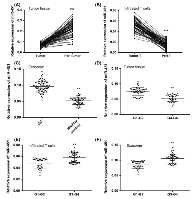 解放军359医院学者发现miR-451可以作为胃癌预后不良的指标