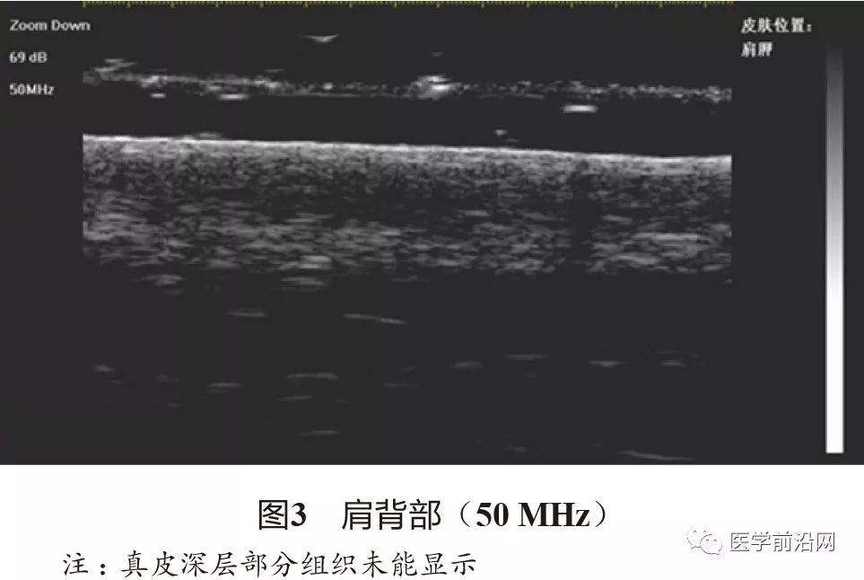 常见皮肤病高频皮肤超声诊断专家共识全文发布
