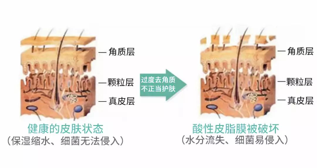 角质层薄脸上有红血丝怎么调理,角质层薄有红血丝脸发红怎么修复