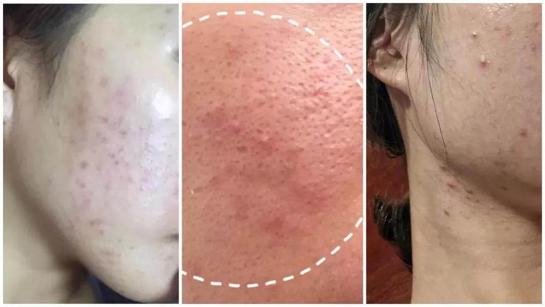 全球公认最好的10款祛痘膏,超好用的一款祛痘膏