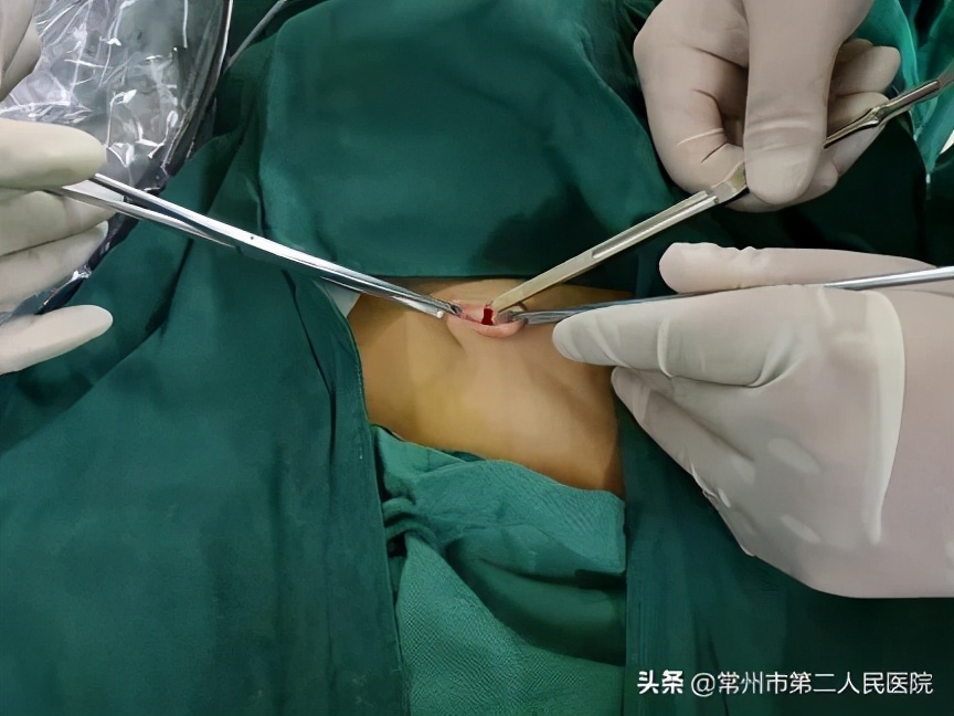 常州二院妇科：安全高效美丽无痕“微创”与“美容”完美结合
