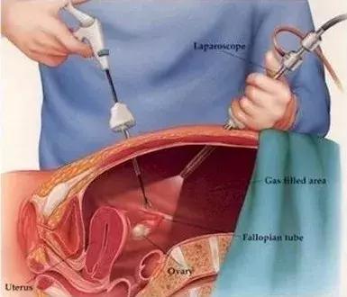 割个阑尾被当堕胎？现代腹腔镜手术先驱的棺材板要压不住了