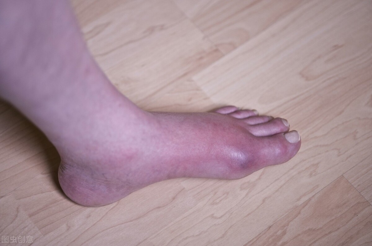 什么是痛风痛风怎么治疗最快最好,什么是痛风症状完全缓解