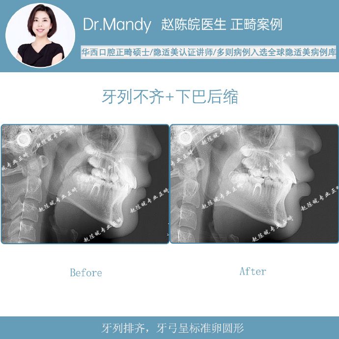 杭州牙齿隐形矫正,杭州成人隐形矫正牙齿优惠