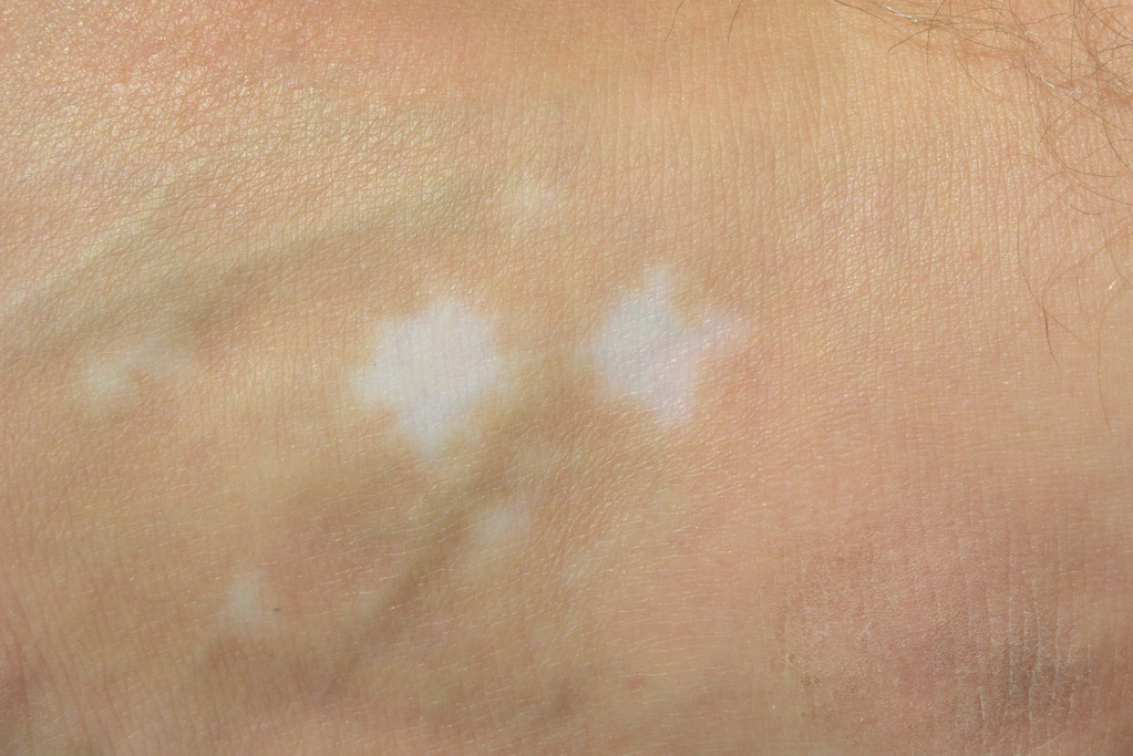 小儿白癜风病初期症状是什么,儿童白癜风病早期症状和前兆