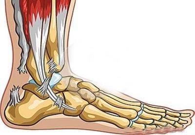 跟腱断裂原因分析,跟腱断裂发病机制
