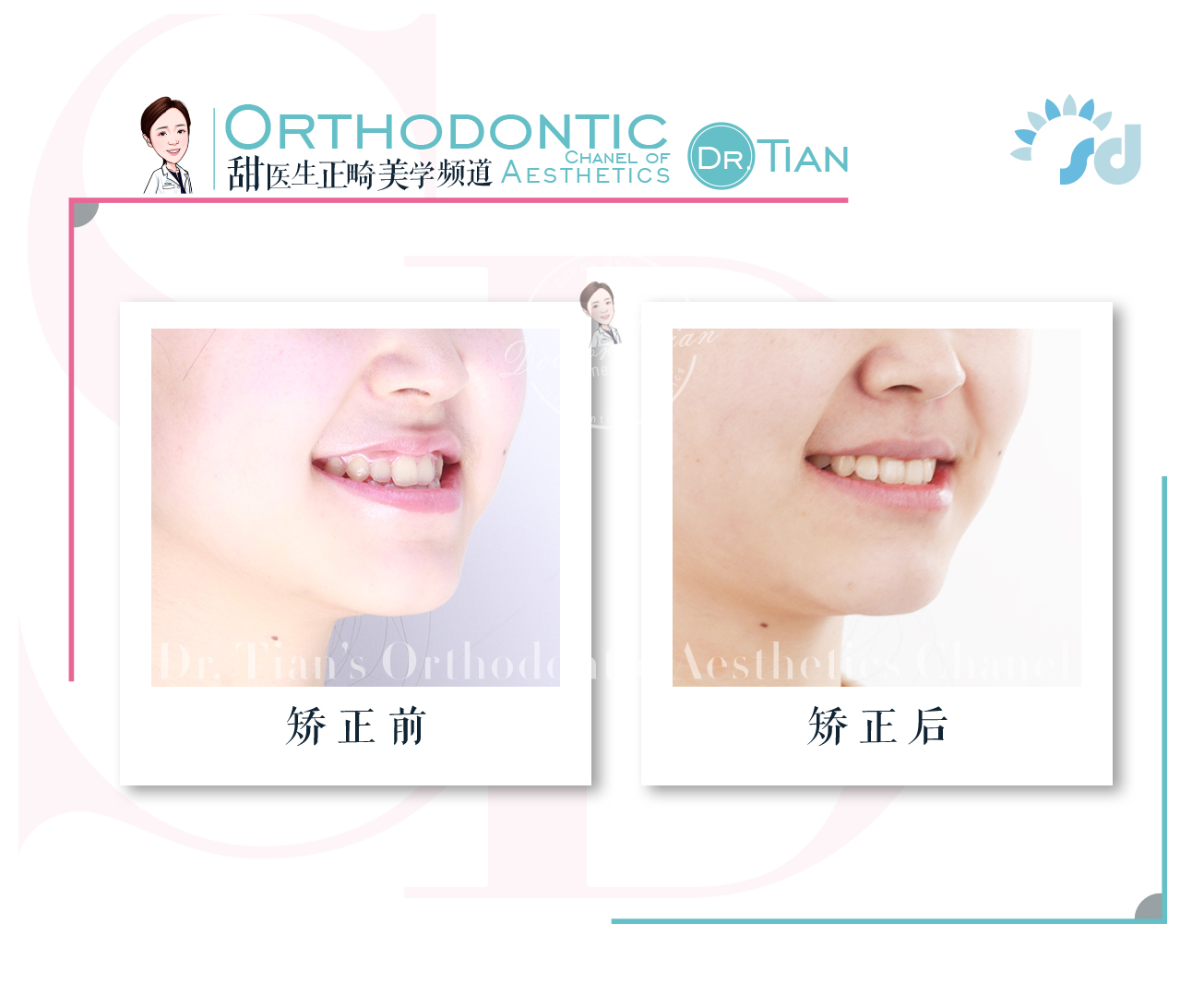 西安哪里有做牙齿矫正,在西安哪里可以做牙齿矫正