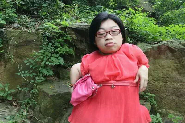 身高89厘米的脆骨女面临“死亡组合”艰难产子：为爱不后悔