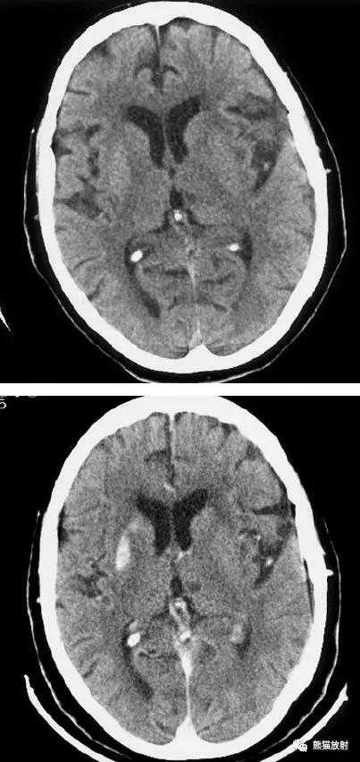 脑梗死丨演变、血供区域分布、CT表现