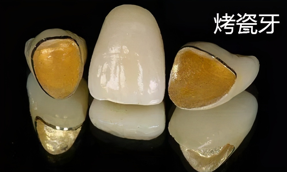 烤瓷牙和全瓷牙的价格有多大区别,烤瓷牙和全瓷牙价格的区别