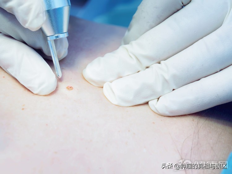 有痣别乱点这2种方法祛痣才靠谱,痣发生病变的几率