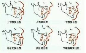 改变凸嘴的方法,如何改变凸嘴的方法