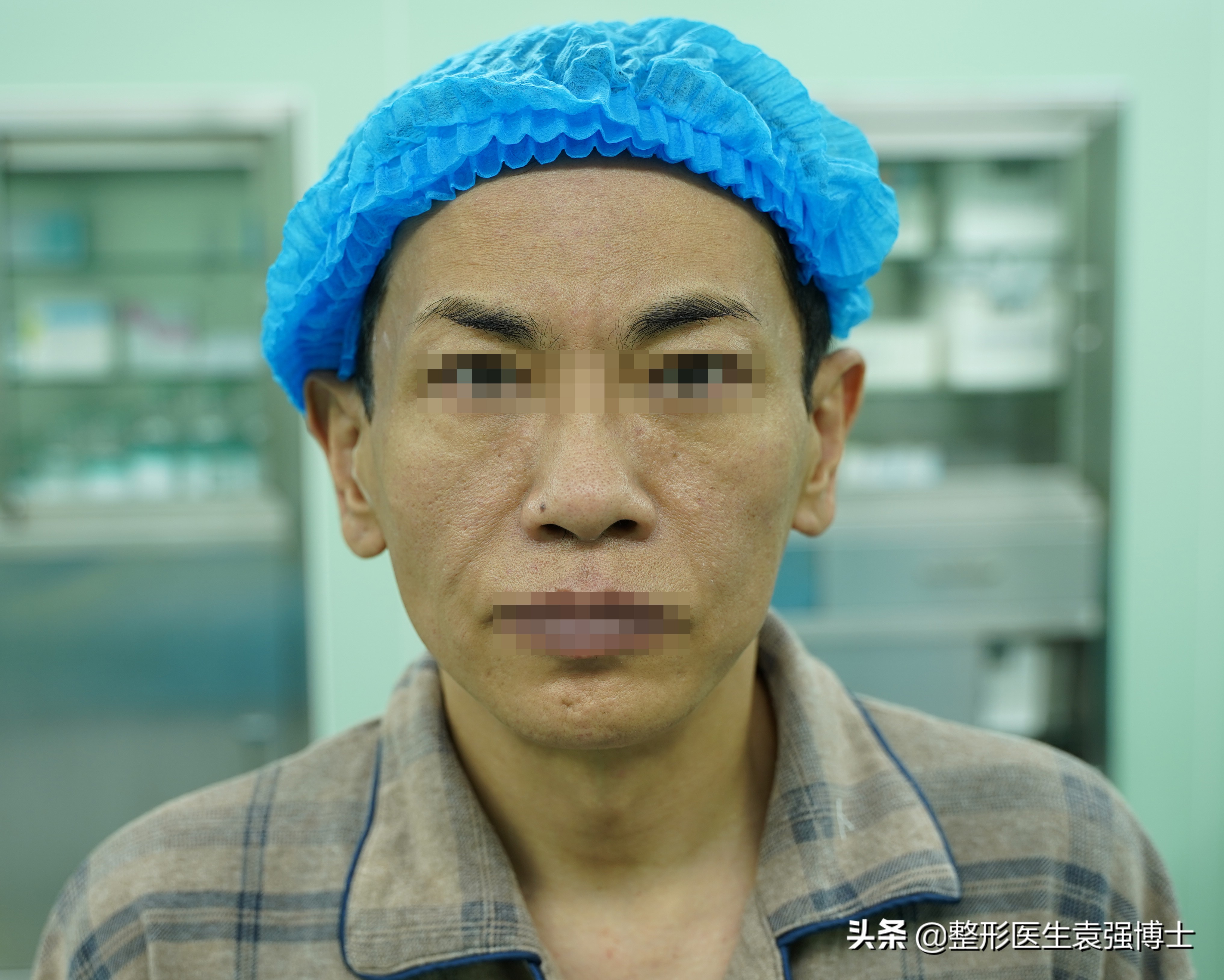 拉皮手术前后对比25岁,男士拉皮手术前后的对比效果