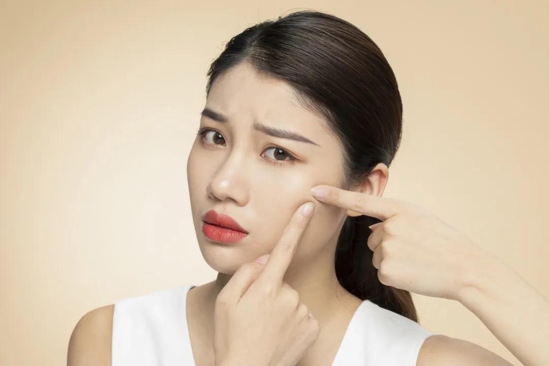 鼻子上闭合性粉刺,面部闭合性粉刺怎么消除