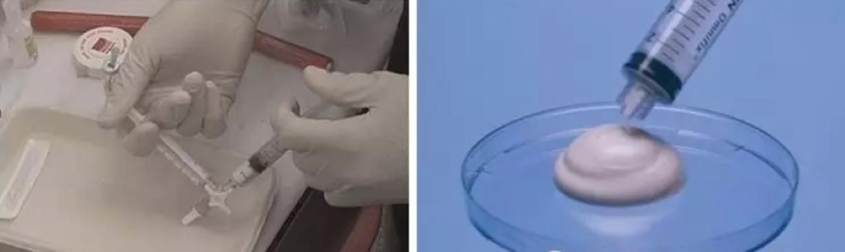 隔壁老王说静脉曲张可以打针治疗!这是真的吗?