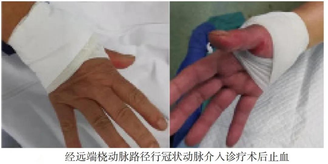 桡动脉介入治疗护理要点,经桡动脉行冠状动脉造影术的护理