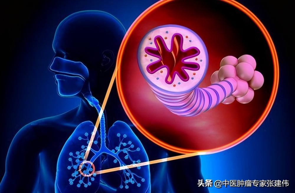 肺癌患者咯血怎么办?肿瘤医生:这份指南请收好