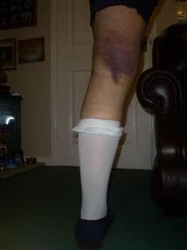 膝关节置换术后伤口渗液,膝关节置换后伤口渗出怎么办