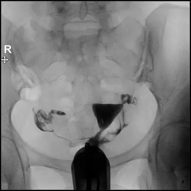 三亚妇幼保健院输卵管造影无痛,石家庄哪个医院有无痛输卵管造影