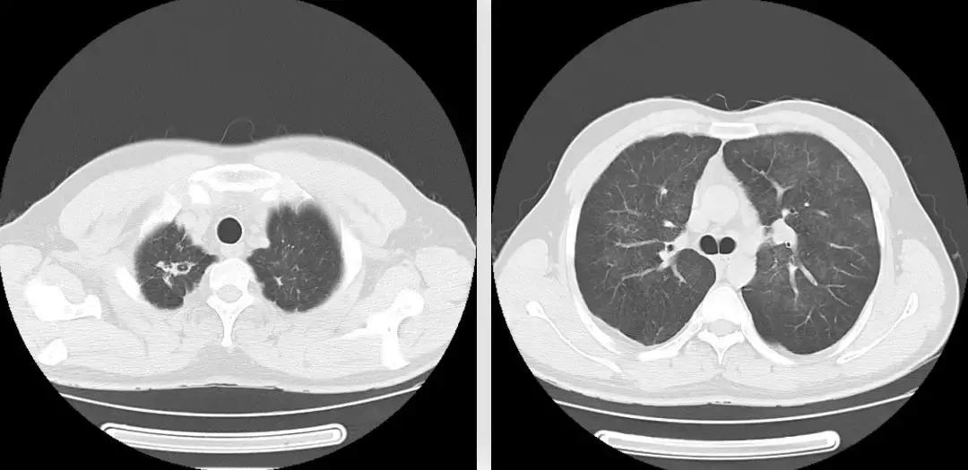 青年男性肺炎过后一直咳嗽怎么办,潜伏结核感染咳嗽咳痰