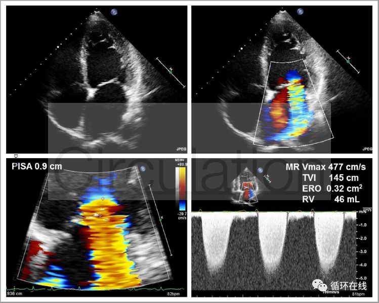 沙库巴曲缬沙坦能逆转心脏重构吗,沙库巴曲缬沙坦钠片心悸可以用吗