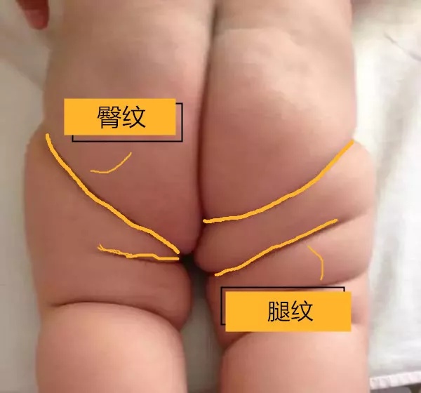 髋关节发育不对称怎么办,腿纹不对称髋关节发育不良