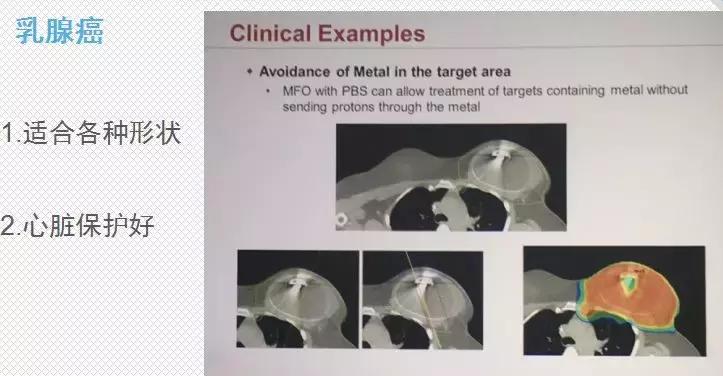 质子治疗适用于什么癌症,质子治疗癌症的疗效咋样