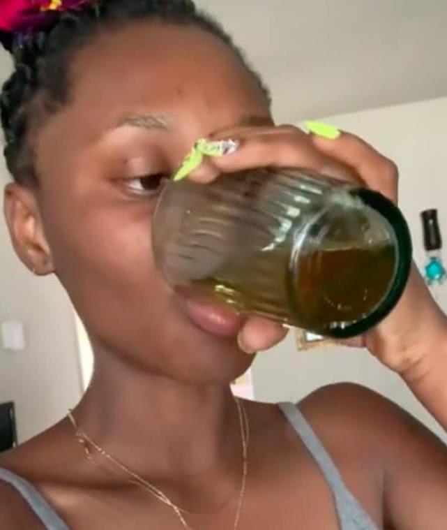 26岁女子治疗脱发,尿液治脱发