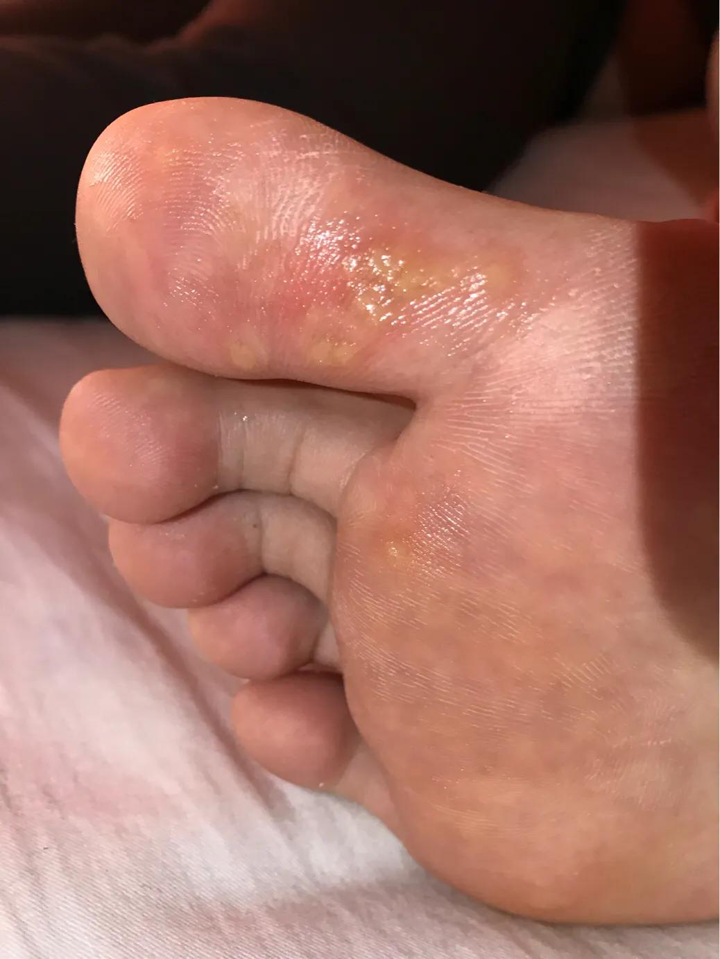 跖疣治好的前兆,跖疣治好的案例