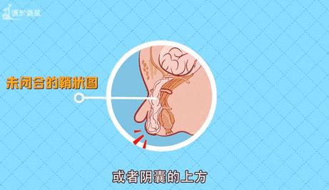 宝宝疝气怎么手法复位,宝宝疝气什么时候动手术最佳