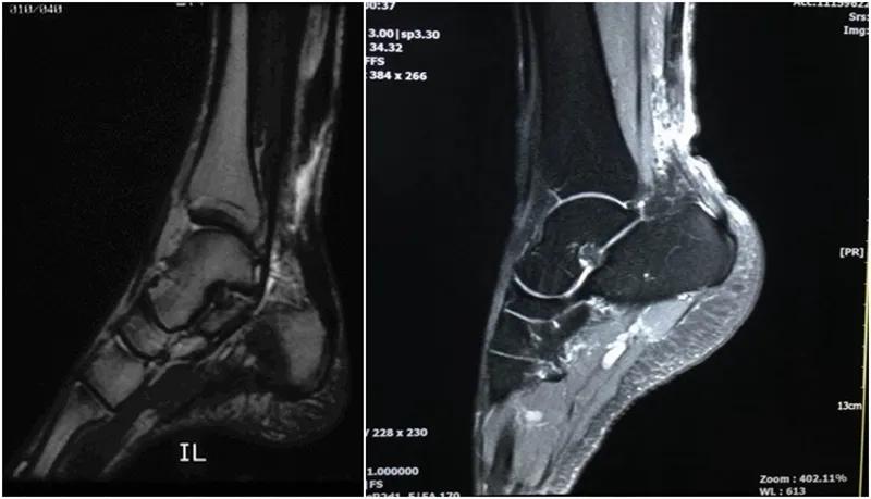 跟腱断裂术后康复训练,跟腱断裂恢复的小偏方