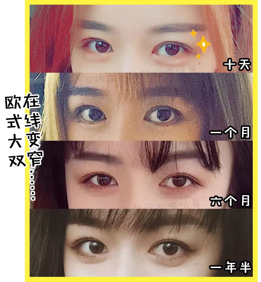 割双眼皮术前术后对比图,割双眼皮术前需要注意事项