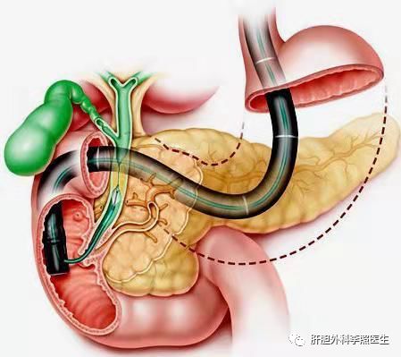 胆囊切除手术后一点不痛怎么回事,胆囊切除后没休息好肚子隐痛