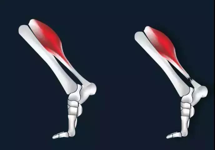 跟腱断裂原因分析,跟腱断裂发病机制