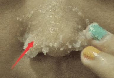 鼻头螨虫有什么药可以根治,鼻头上有螨虫用什么药