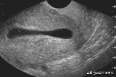 内见卵黄囊,卵黄囊肿瘤