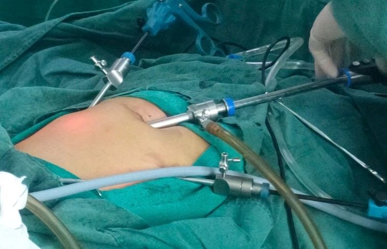 疝气哪种手术治疗最好不易复发,疝气做了两次手术又复发了怎么办