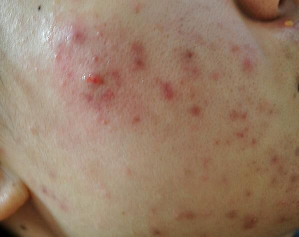 痘痘反复长?不内调再大牌的护肤品都没效果,这三招帮你远离痘痘