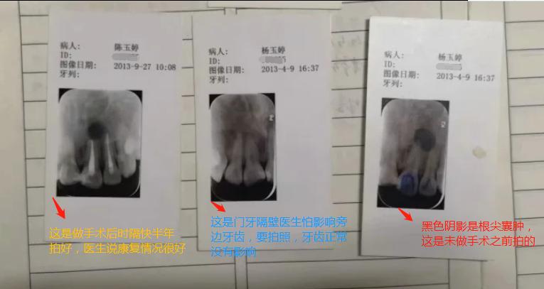 种门牙的亲身经历,种牙的心酸历程全文