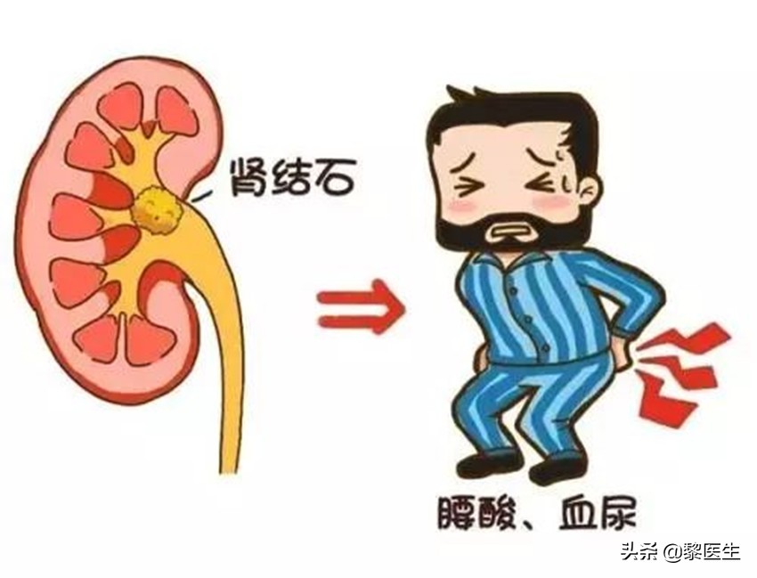 查出了肾结石不痛需要打掉吗,查出肾结石但是没有感觉