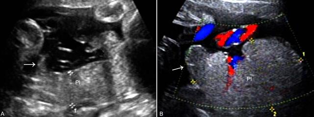 异常胎盘超声,胎盘异常的超声诊断