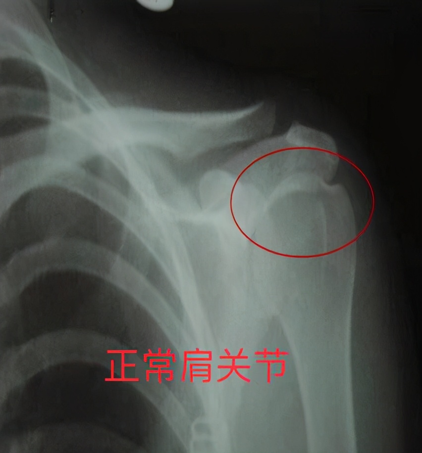 卒中后怎么恢复身体,偏瘫患者肩胛骨后凸