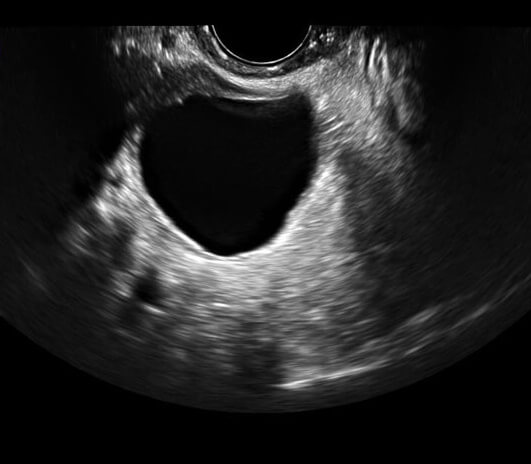 大马妇女做囊肿手术仅花85元,住院7天共364元,大呼祖国好