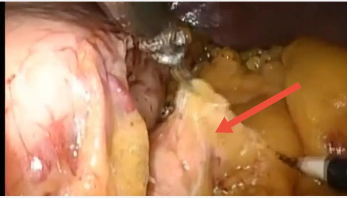 腹腔镜胰体尾切除术打孔位置,胰体尾肿瘤切除后复查哪些