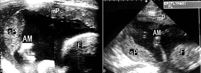 异常胎盘超声,胎盘异常的超声诊断