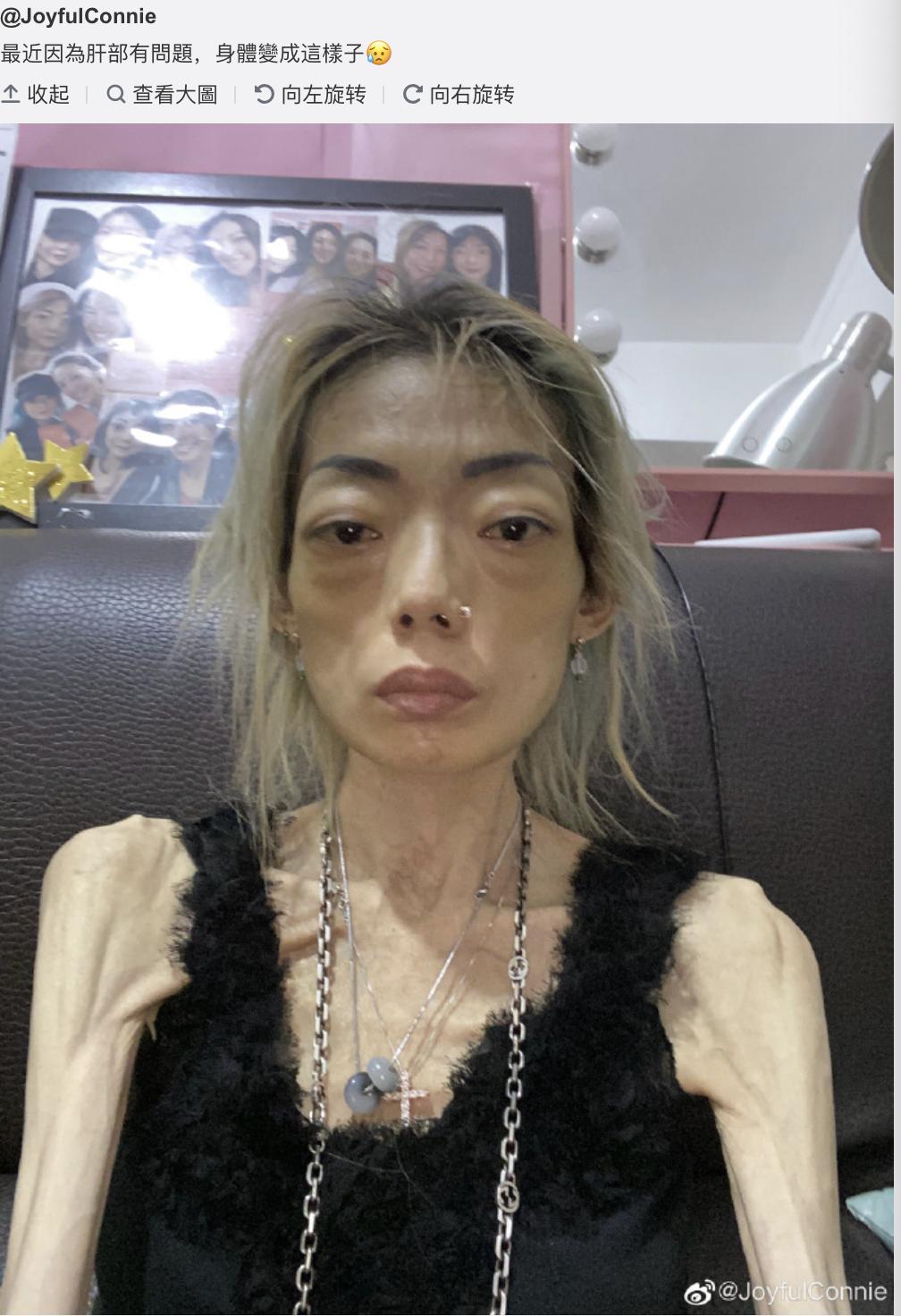 郭永淳前妻罕露脸精神尚可,仍暴瘦如柴,靠拍卖名牌赚钱筹医药费