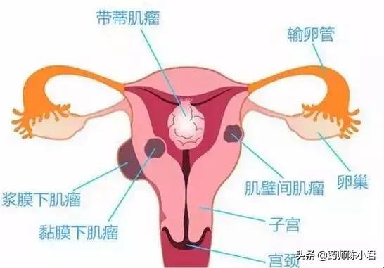 53岁张阿姨月经出血期特别长,腰酸,腹痛,医生说:子宫全切!