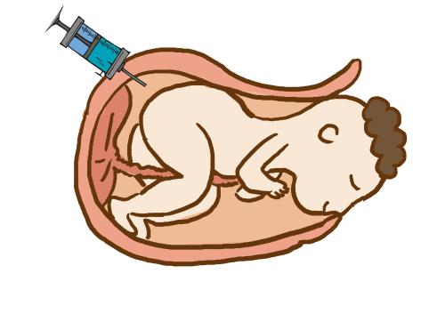 妇产科医生:什么是羊水穿刺?哪些孕妈妈需要做这个检查?